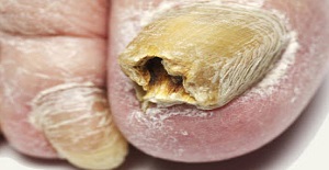 A Natural Cure For Nail Fungus Your Doctor Won't Tell You (Watch)